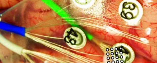 Se puede hablar con el pensamiento | Cortesía Universidad de Utah | Se ve la disposición de los electrodos instalados en el cerebro para captar y traducir las señales del paciente. Arriba, áreas relacionadas con el lenguaje.