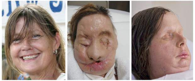 Así fue la agresión de Charla Nash | Reuters | La combinación de fotos muestra a Charla Nash antes del ataque, luego de la mutilación por parte del chimpancé y su nuevo rostro tras el trasplante.