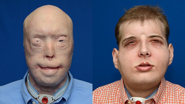 Patrick Hardison, de 41 años, recibió el trasplante de rostro más grande hasta ahora. FOTO AFP