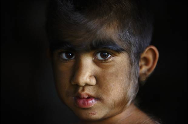 Reuters - La esperanza de vida de las personas que padecen este s&#237;ndrome es la misma que la de una persona normal.