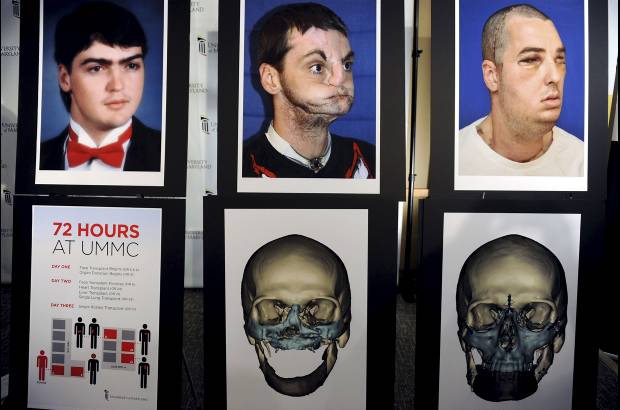 Foto Reuters - La operaci&#243;n de 36 horas fue la m&#225;s extensa debido a que incluy&#243; trasplante de dientes, lengua, mand&#237;bula superior e inferior y todo el tejido facial desde el cuero cabelludo hasta la base del cuello, dijo el cirujano jefe. Como incluy&#243; tanto tejido, las incisiones est&#225;n m&#225;s alejadas y son menos visibles, agreg&#243;.