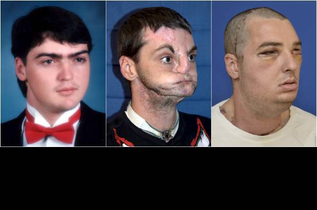 Reuters - El estadounidense Richard Lee Norris, de 37 a&#241;os, quien en 1997 se hiri&#243; en un accidente con armas, recibi&#243; nueva cara, dientes, lengua y mand&#237;bula en lo que los m&#233;dicos consideran es el trasplante de cara m&#225;s extenso jam&#225;s realizado.