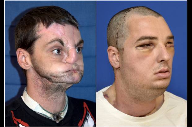 Foto Reuters - Funcionarios del Centro M&#233;dico de la Universidad de Maryland anunciaron que Richard Lee Norris convalece bien tras la operaci&#243;n de la semana pasada, que empieza a sentir su cara y que ya se est&#225; cepillando los dientes y afeitando. Tambi&#233;n recuper&#243; su sentido del olfato, que hab&#237;a perdido despu&#233;s del accidente.