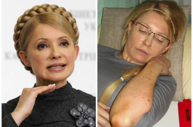 AP - La prensa ucraniana public&#243; este viernes fotos en las que se aprecian los moratones sufridos por la l&#237;der opositora, Yulia Timoshenko, supuestamente a manos de los funcionarios de la prisi&#243;n donde cumple siete a&#241;os de condena por abuso de poder.