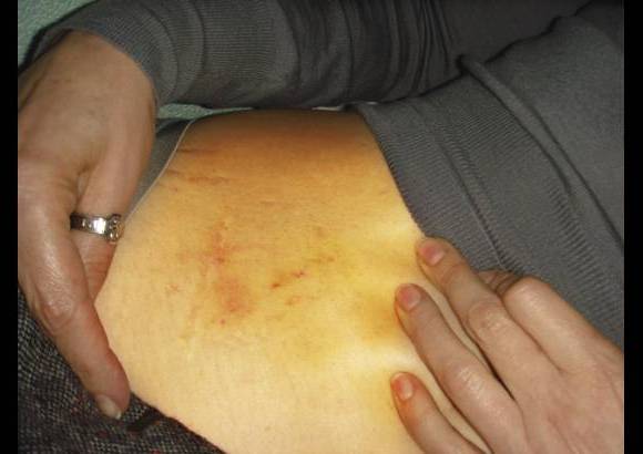 Reuters - Tambi&#233;n en algunas fotos aparece con lesiones en un brazo y un codo, que supuestamente le infligieron el pasado viernes tres hombres cuando se neg&#243; a abandonar la c&#225;rcel de la ciudad oriental de J&#225;rkov para someterse a rehabilitaci&#243;n por la hernia discal que padece.