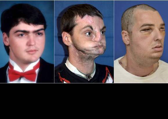 Reuters - El estadounidense Richard Lee Norris, de 37 a&#241;os, quien en 1997 se hiri&#243; en un accidente con armas, recibi&#243; nueva cara, dientes, lengua y mand&#237;bula en lo que los m&#233;dicos consideran es el trasplante de cara m&#225;s extenso jam&#225;s realizado.