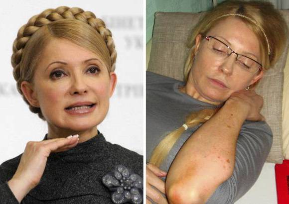 AP - La prensa ucraniana public&#243; este viernes fotos en las que se aprecian los moratones sufridos por la l&#237;der opositora, Yulia Timoshenko, supuestamente a manos de los funcionarios de la prisi&#243;n donde cumple siete a&#241;os de condena por abuso de poder.