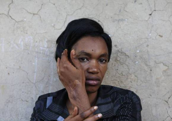 Reuters - Mudahogora Ernestine, de 34 años, aparece fuera de su casa en los suburbios de la capital de Ruanda, Kigali. Es la única de su familia que sobrevivió a los asesinatos en masa en el genocidio de 1994, cuando tenía siete años. Ella quedó con heridas visibles en el cuello, las manos y otras partes de su cuerpo.