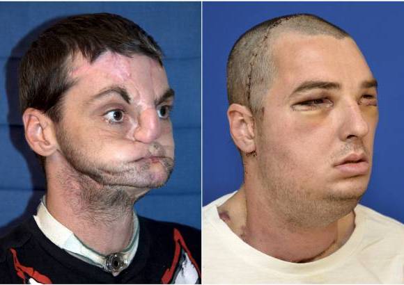 Foto Reuters - Funcionarios del Centro M&#233;dico de la Universidad de Maryland anunciaron que Richard Lee Norris convalece bien tras la operaci&#243;n de la semana pasada, que empieza a sentir su cara y que ya se est&#225; cepillando los dientes y afeitando. Tambi&#233;n recuper&#243; su sentido del olfato, que hab&#237;a perdido despu&#233;s del accidente.
