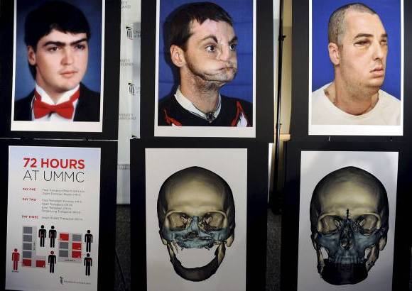 Foto Reuters - La operaci&#243;n de 36 horas fue la m&#225;s extensa debido a que incluy&#243; trasplante de dientes, lengua, mand&#237;bula superior e inferior y todo el tejido facial desde el cuero cabelludo hasta la base del cuello, dijo el cirujano jefe. Como incluy&#243; tanto tejido, las incisiones est&#225;n m&#225;s alejadas y son menos visibles, agreg&#243;.