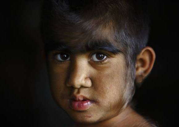 Reuters - La esperanza de vida de las personas que padecen este s&#237;ndrome es la misma que la de una persona normal.