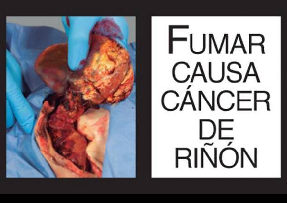 Foto Cortesía - El Ministerio de Salud y Protección Social publicó las imágenes de advertencia sanitarias para las cajetillas de cigarrillo 2013 - 2014, de acuerdo a la resolución 3961 del 2009, por la cual se establecen los requisitos de empaquetado y etiquetado del tabaco y sus derivados.
