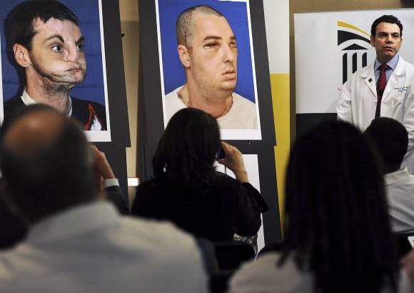 Foto Reuters - Norris ha pasado los &#250;ltimos quince a&#241;os viviendo como un recluso, y el trasplante le permitir&#225; recuperar su vida, afirm&#243; el Dr. Eduardo Rodr&#237;guez, el cirujano jefe de la intervenci&#243;n.
