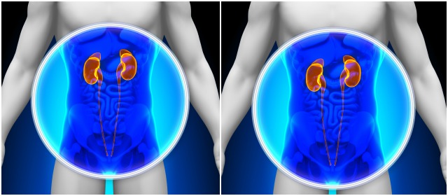 Cuídese, para que el cáncer no lo sorprenda | En cáncer renal hay muchos subtipos de tumores, cada uno tiene unas características independientes, dice el urólogo-oncólogo Carlos Humberto Martínez. FOTO SHUTTERSTOCK