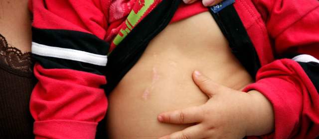 Quemadura con pólvora, huella que no se borra de la piel ni del alma | Así quedaron las huellas de la pólvora en el cuerpo del bebé Maicol. FOTO MANUEL SALDARRIAGA