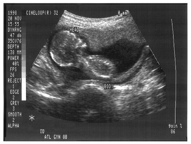Imagen de ultrasonido de un feto de cuatro meses. En el útero se hazi trasplante de células madres. Foto Public Domain