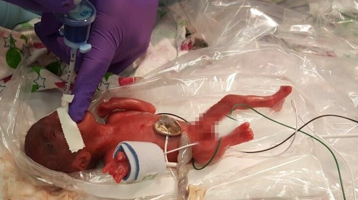 Nace el bebé más pequeño del mundo, pesó lo mismo que una manzana
