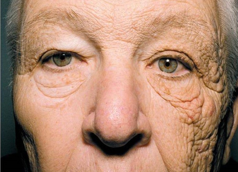 Las huellas en el rostro de una persona que condujo un camión durante 28 años y recibió el sol a través de la ventanilla izquierda. Foto: www.nejm.org