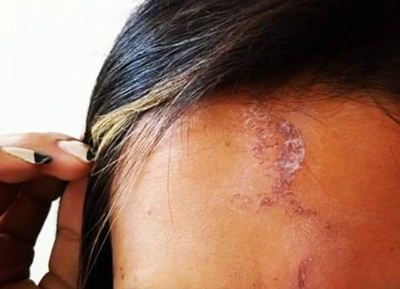 Esta fue la herida que sufrió una de las personas afectadas. FOTO www.mioriente.com