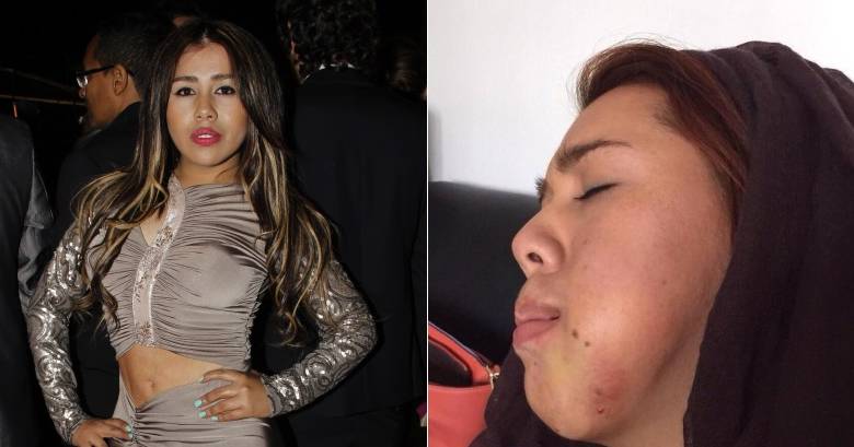 Yina Calderón, quien se hizo famosa por el reality ‘Protagonistas de Novela’, fue internada en un hospital después de, al parecer, haberse inyectado una sustancia en la cara. FOTO LA RED