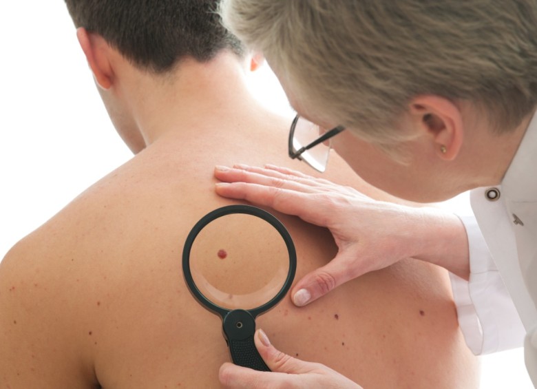 La exposición excesiva a la radiación ultravioleta es una de las causas del cáncer de piel. Foto: Shutterstock