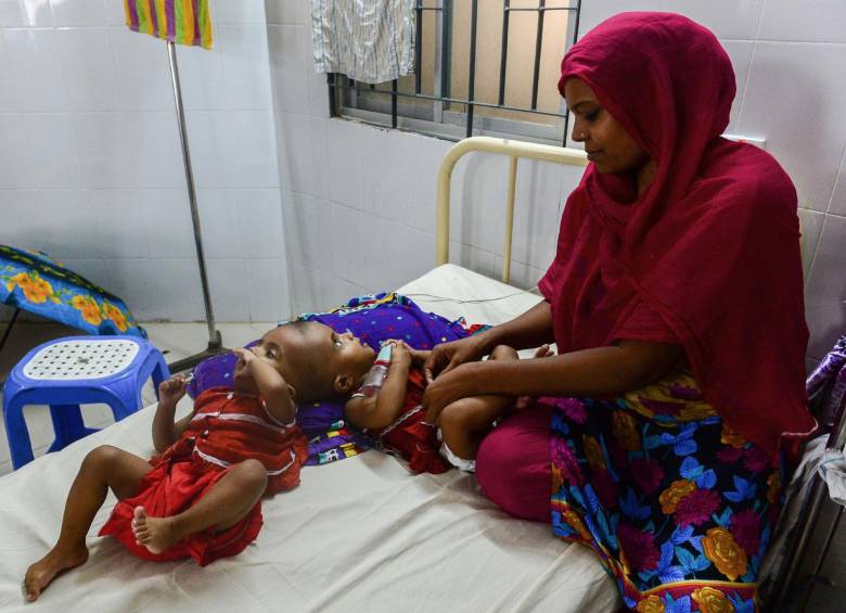 Gemelas unidas por el cráneo serán sometidas a riesgosa cirugía