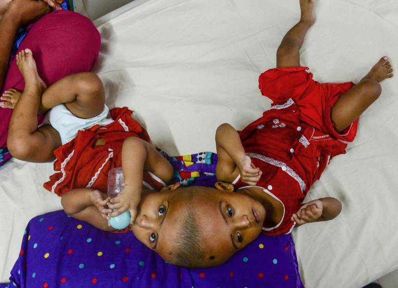 Gemelas unidas por el cráneo serán sometidas a riesgosa cirugía