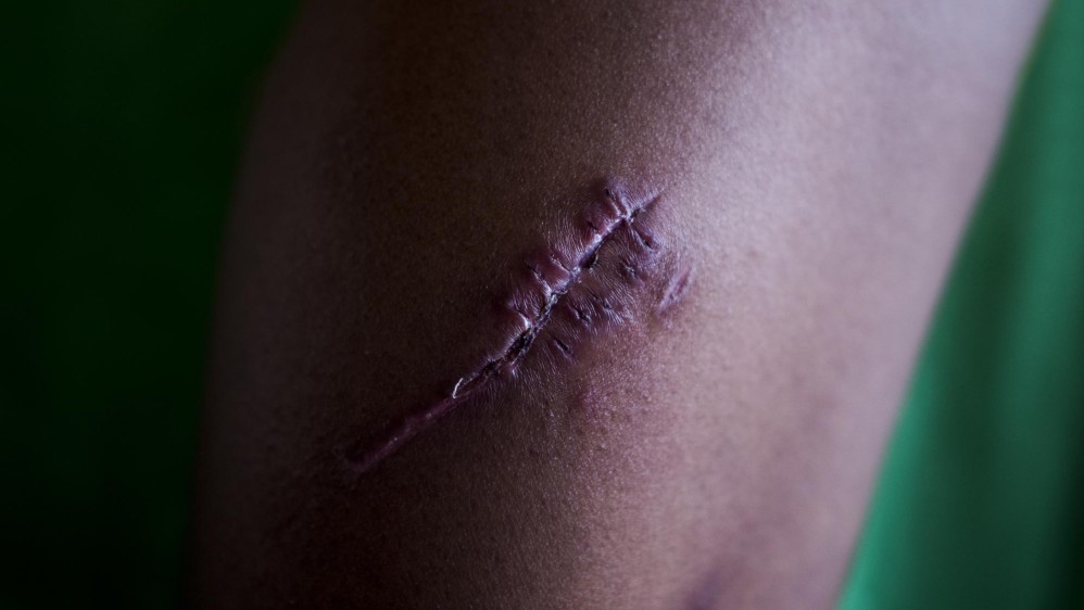 Herida de arma cortopunzante en la pierna de Melissa Puello. Foto: Charlie Cordero 